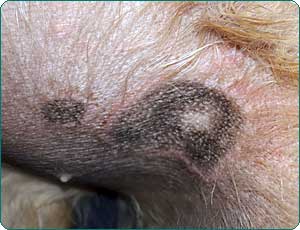 Erythematöse circuläre Dermatitis mit Hyperpigmentation